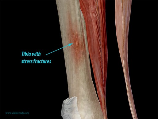 Hold On To Your Tibias The Anatomy And Causes Of Shin Splints 6440